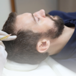 Cegah Kebotakan Sejak Dini dengan PRP Hair Treatment